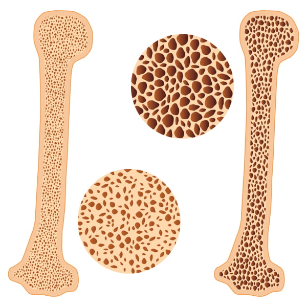 Osteoporos